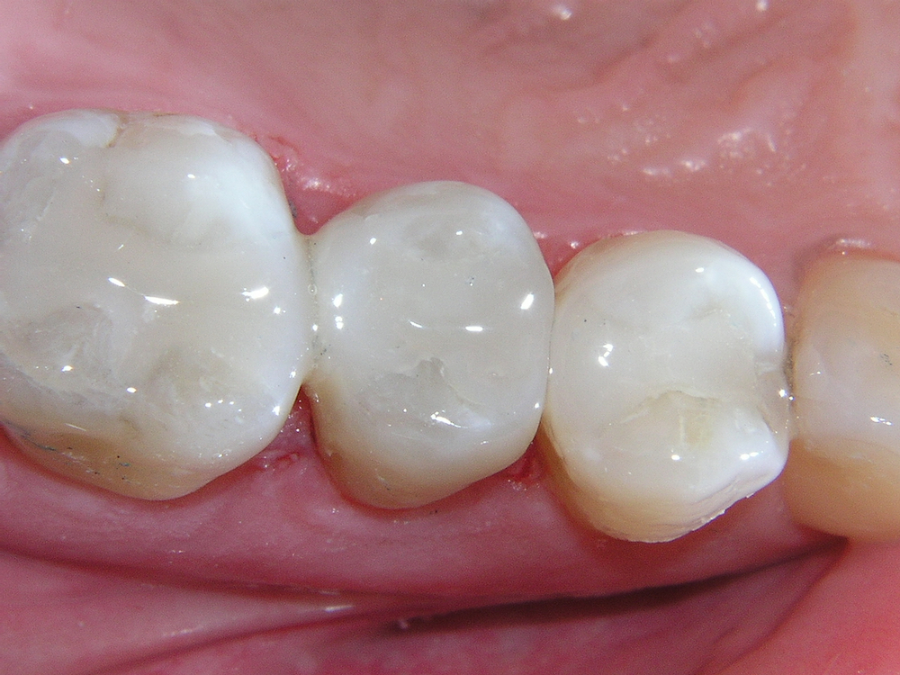 dental fillings murfreesboro tn