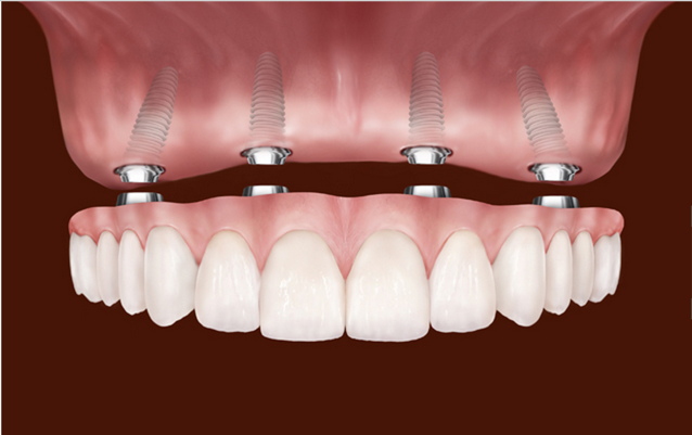 dental implants murfreesboro tn