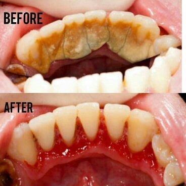 dental scaling before and after murfreesboro tn