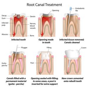 root canal treatments murfreesboro tn