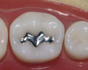 amalgam fillings