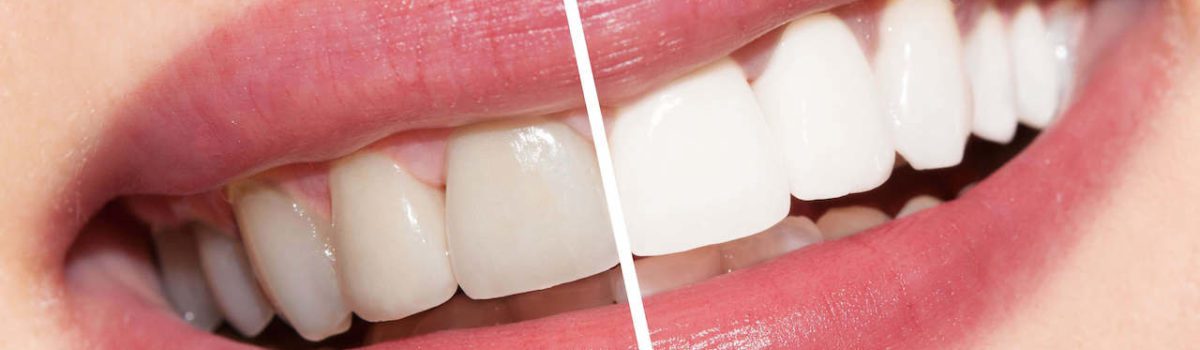 teeth whitening murfreesboro tn