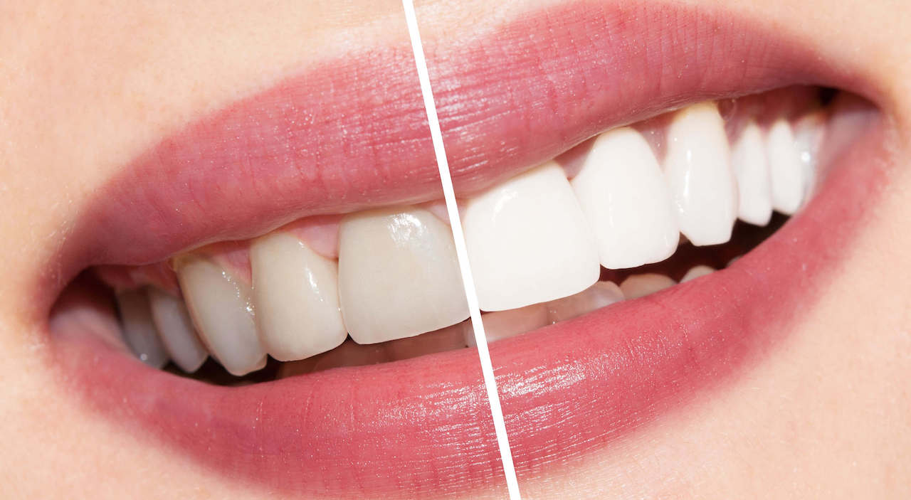 teeth whitening murfreesboro tn