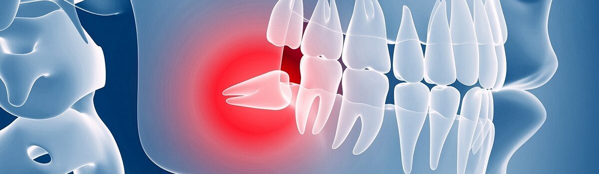 Wisdom Teeth Removal Murfreesboro TN